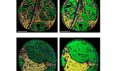 Semana Europea del Cáncer de Pulmón: Avances en la identificación de biomarcadores con GeoMx DSP